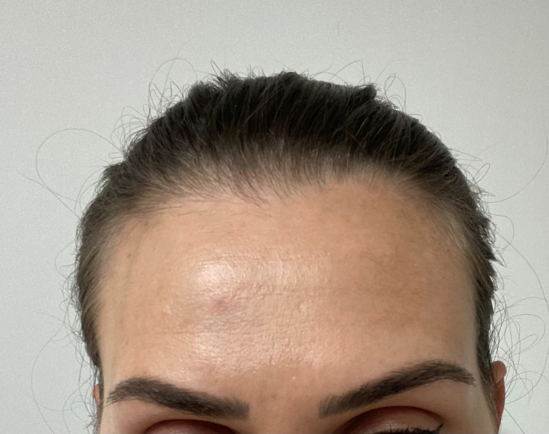 Peeling despigmentante en Porriño