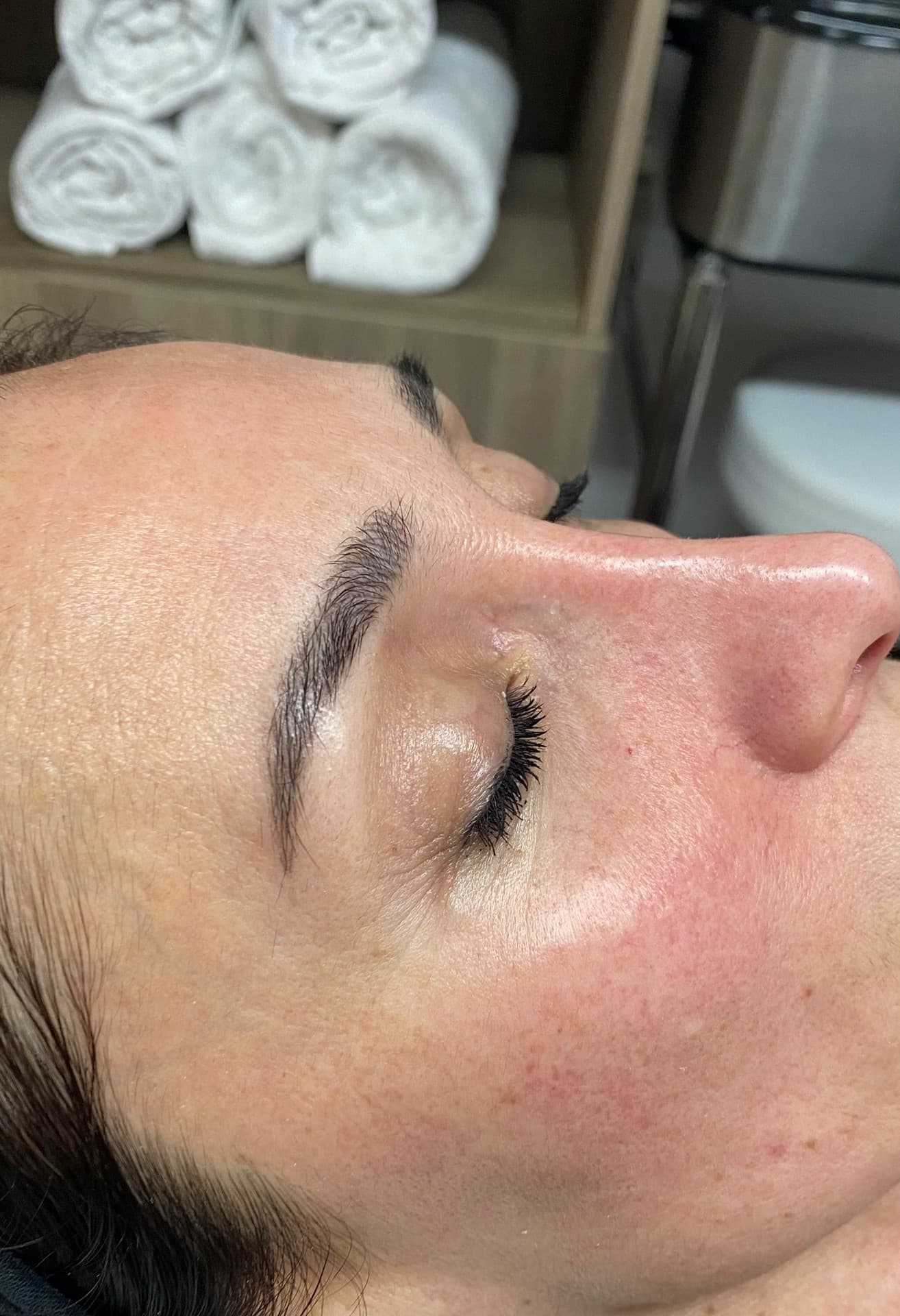 Indiba contorno ojos en Porriño